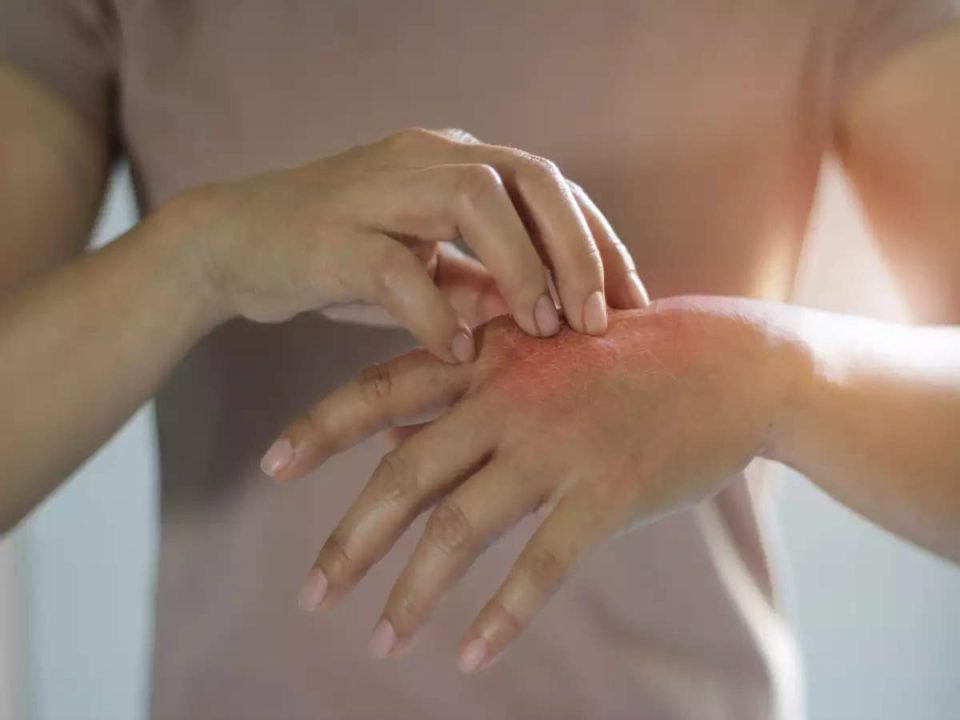 Aggravating skin problem in summer
